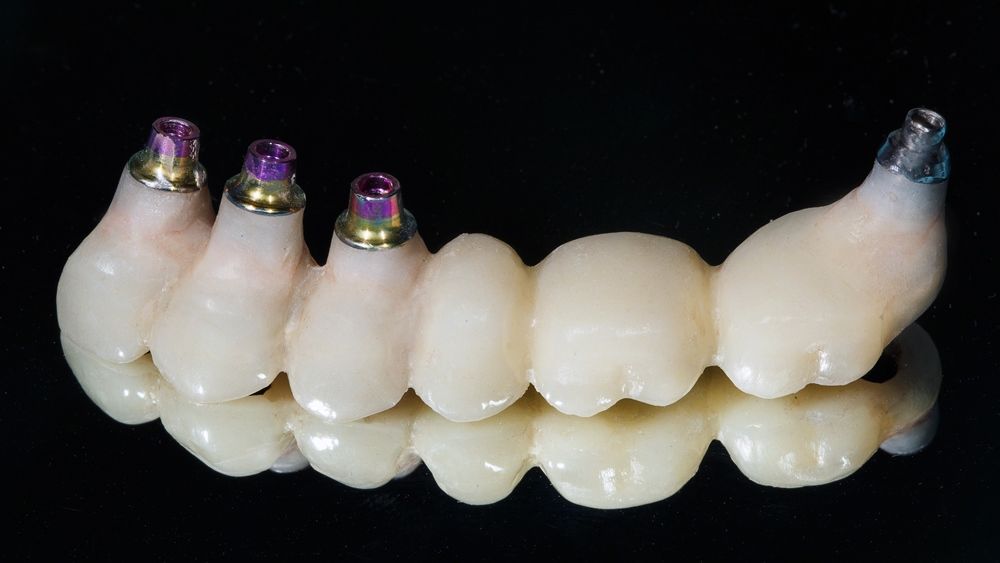 Зубной мост из циркония для протезирования на имплантатах